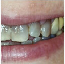Discoloured or yellow teeth