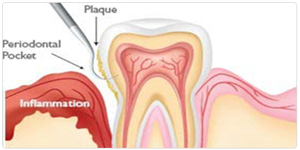 Gum_Periodontal_Infection