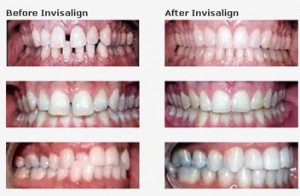 clear braces - US Dental