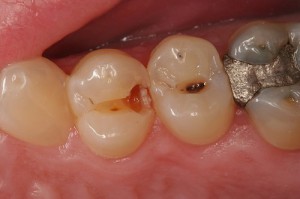 Teeth-decay-or-broken-teeth