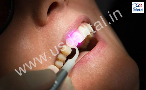 Laser-Teeth-Whitening