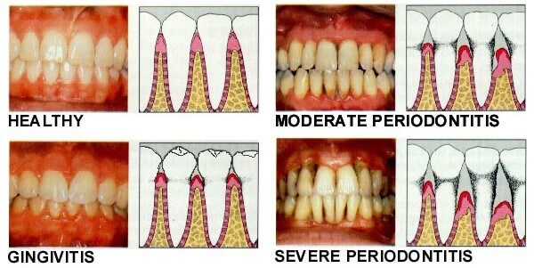 Gum Disease Signs