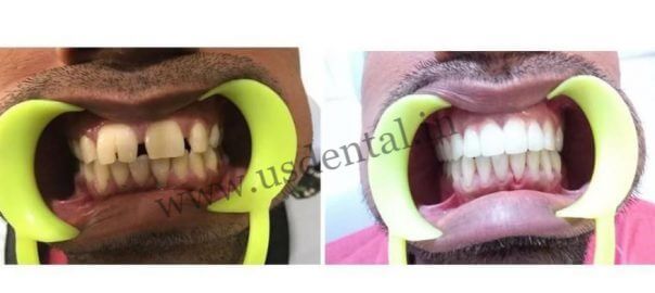 before-after-root-canal-treatment