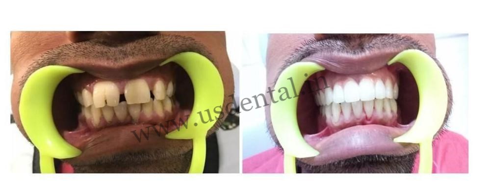 before-after-root-canal-treatment
