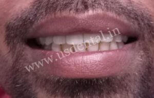 Root-Canal-Treatment-Before-After