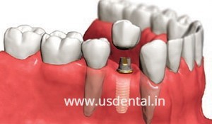 Computer Guided Dental Implant