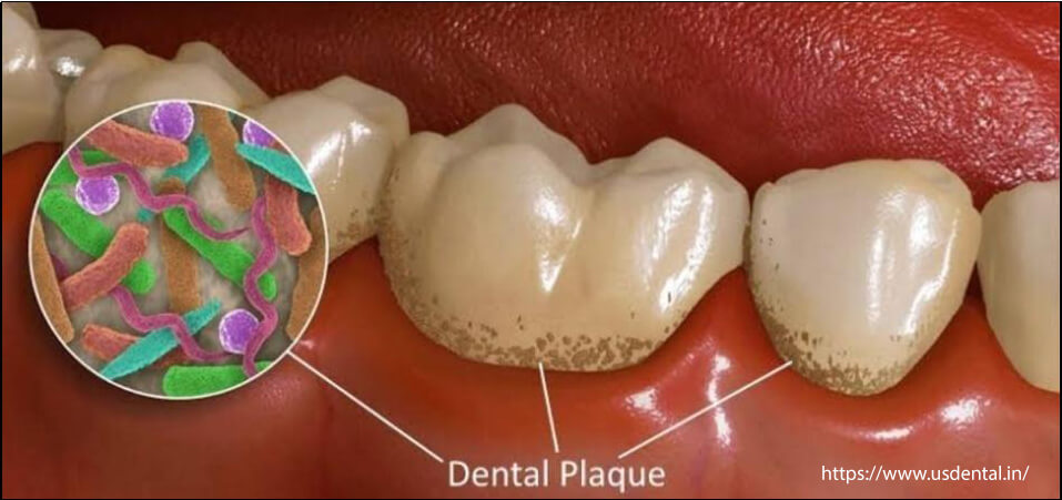 What Is Dental Plaque & How To Remove It