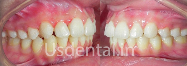 Before and After Misalignment Teeth Alignment – Case of the Month
