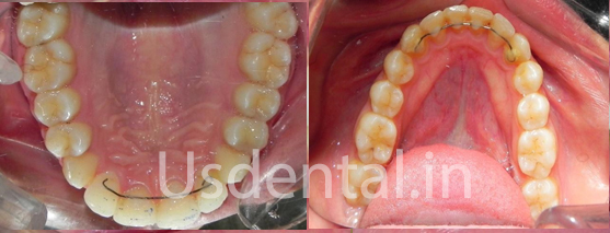 A Permanent Solution Which Lasts Longer Compared to Older Composite Filling - Case of the Month
