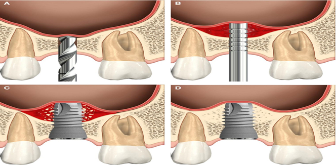 What is Sinus Lift Surgery for Dental Implants? Do I Need One?