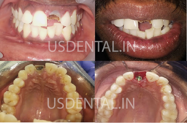 Replacing Missing or Broken Front Teeth - Case of the Month