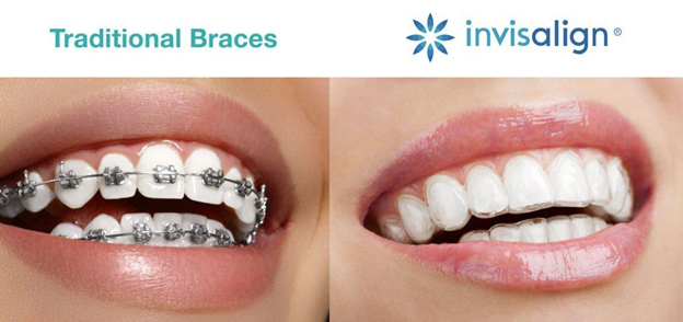 Which Invisible Braces are best?