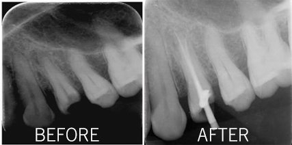 Can Root canal treatment be painless?