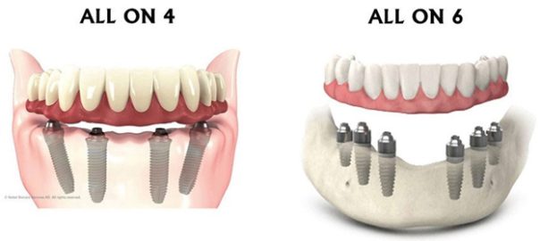 What Is Better Is It All on Four or All on Six Dental Implants?