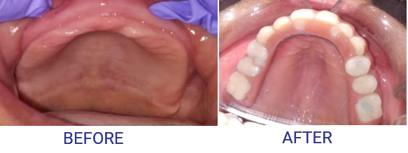 Tooth Pain After a Filling