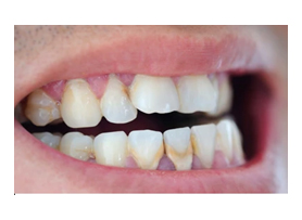Replacing Missing Teeth?