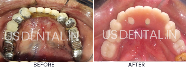 Dental Implants to Replace Missing Back Teeth