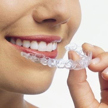Clear Aligners – US Dental