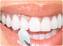 Dental_Cavities