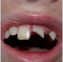 Cracked or chipped teeth