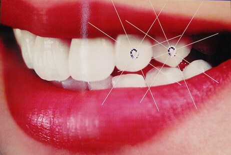Teeth Jewellery Treatment Ahmedabad | Cosmetic Dentistry | US Dental