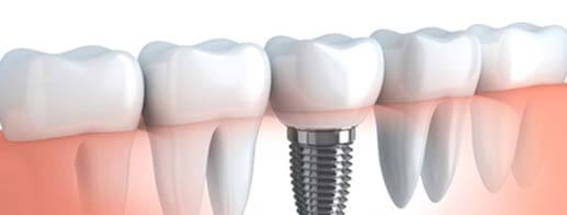 Implant in Ahmedabad