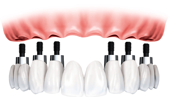 How Laser gum treatment is performed?