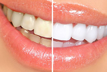 Teeth Whitening