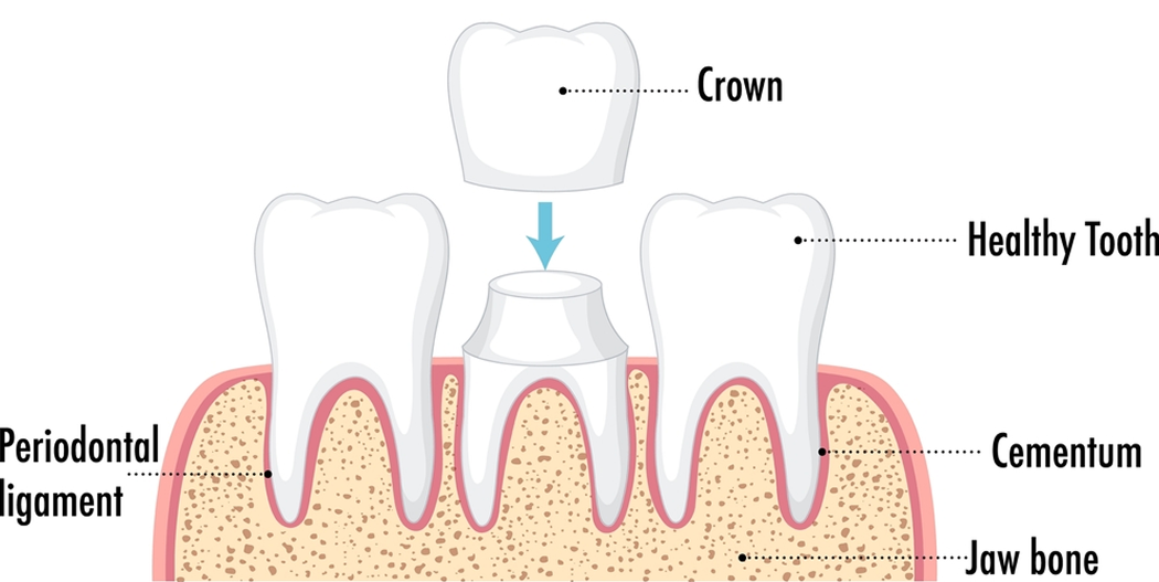 What is Dental Crown?