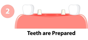 teeth are prepared