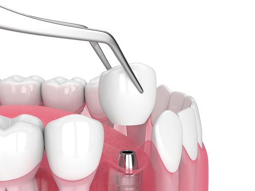 Dental Implants