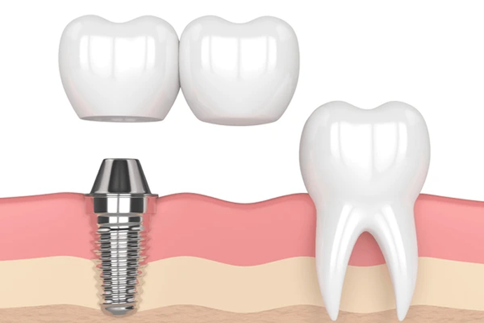  Porcelain-fused-to-metal crowns