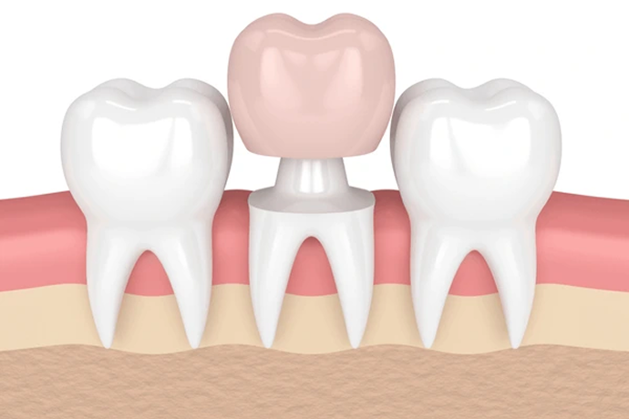 All-ceramic or all-porcelain Crowns