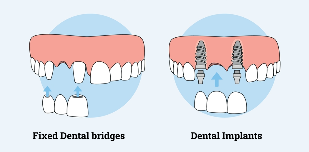 Fixed Dental bridges Vs. Dental Implants