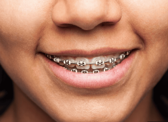 Types of Braces