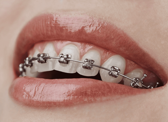 Types of Braces