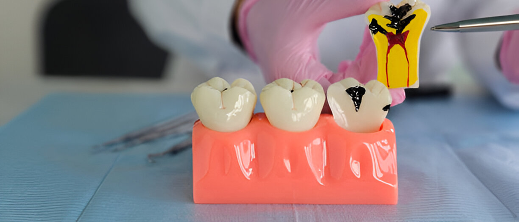 What is Dental Crown?