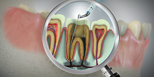 Root Canal