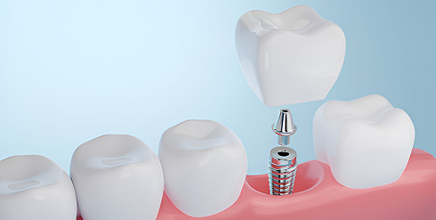 Dental Implant