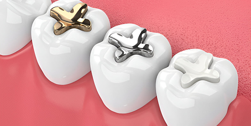 Dental Filling