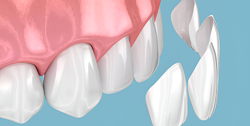 Veneers or Crowns