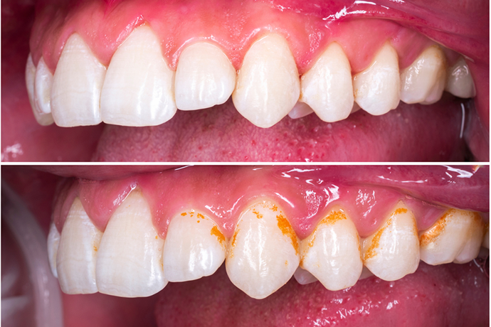  Tooth discoloration