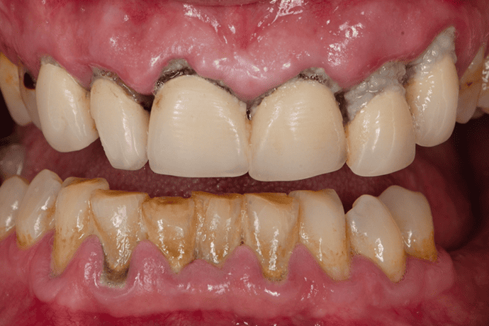 Forms of Periodontitis