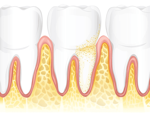 Gum Disease Ahmedabad