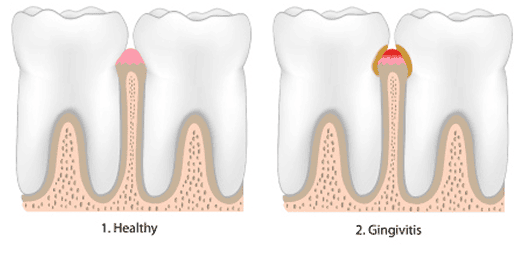 Who can have Gum Disease?