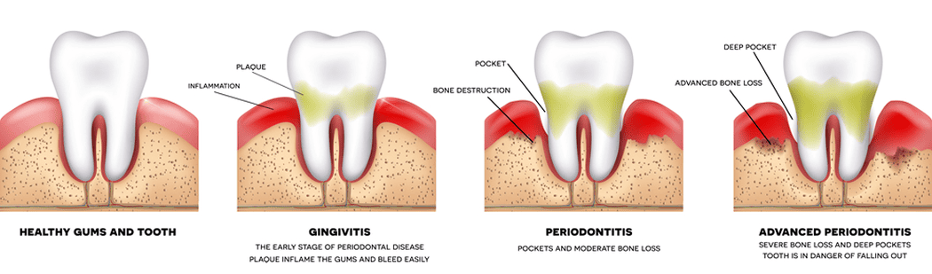 Who can have Gum Disease?