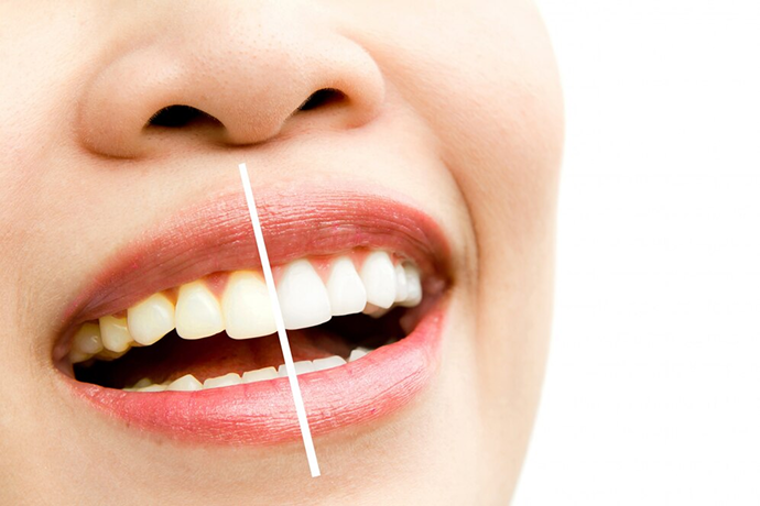 Veneers Fix Problems