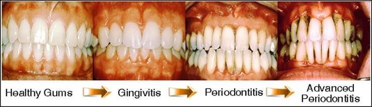 Gums that move away from the tooth