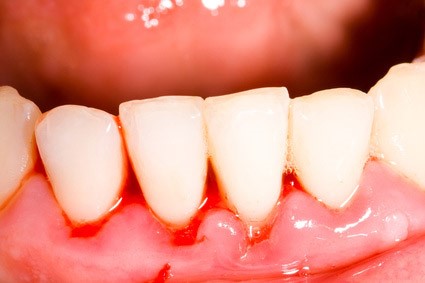 Swollen tender red or bleeding gums