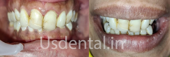 A Permanent Solution Which Lasts Longer Compared to Older Composite Filling - Case of the Month
